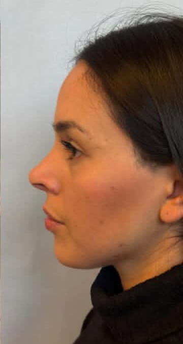 After Rhinoplasty